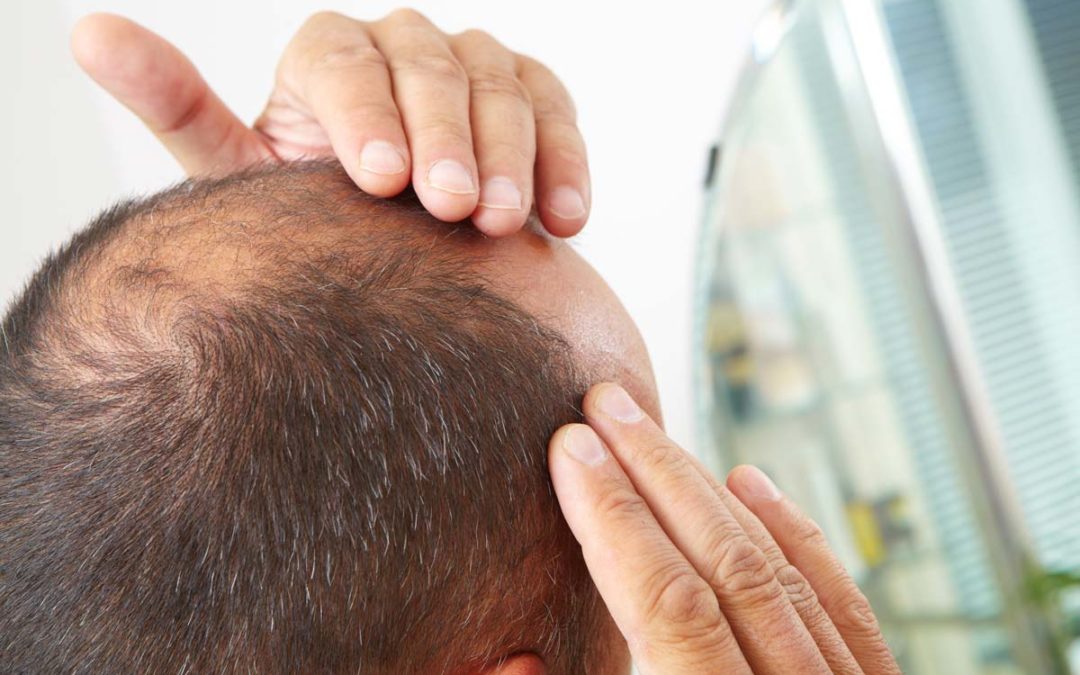 3 Balding Myths Debunked