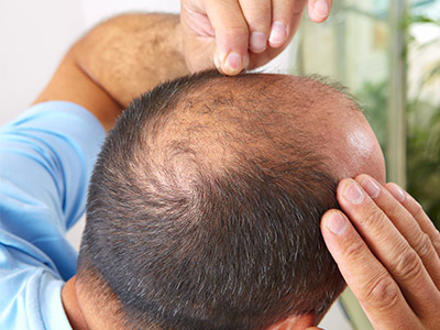 3 Ways to Slow Balding